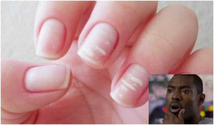 Las manchas blancas en las uñas no aparecen por falta de calcio ni tampoco son hongos